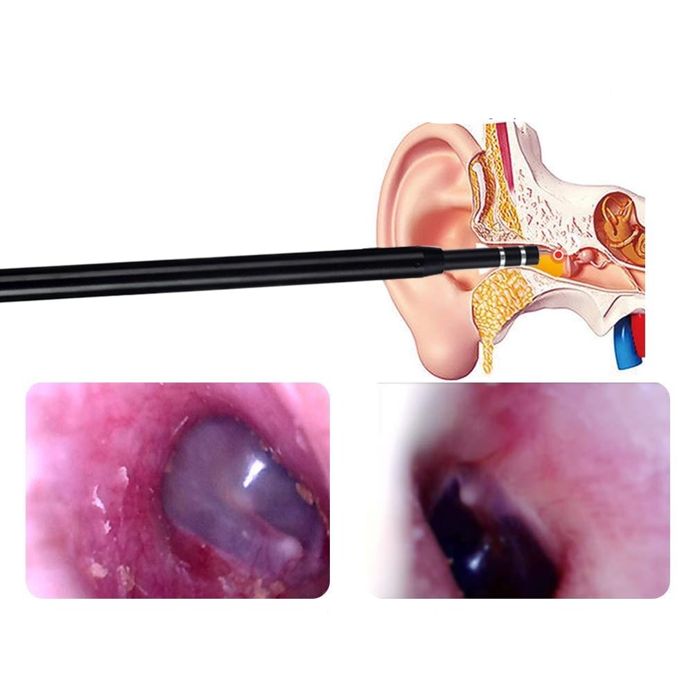 Live Ear Medicinal ear endoscope.